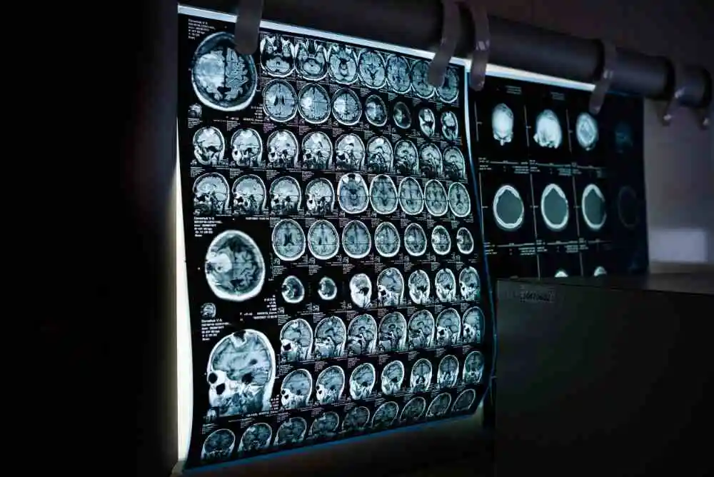 Brain Stroke Treatment Options and Mechanical Thrombectomy
